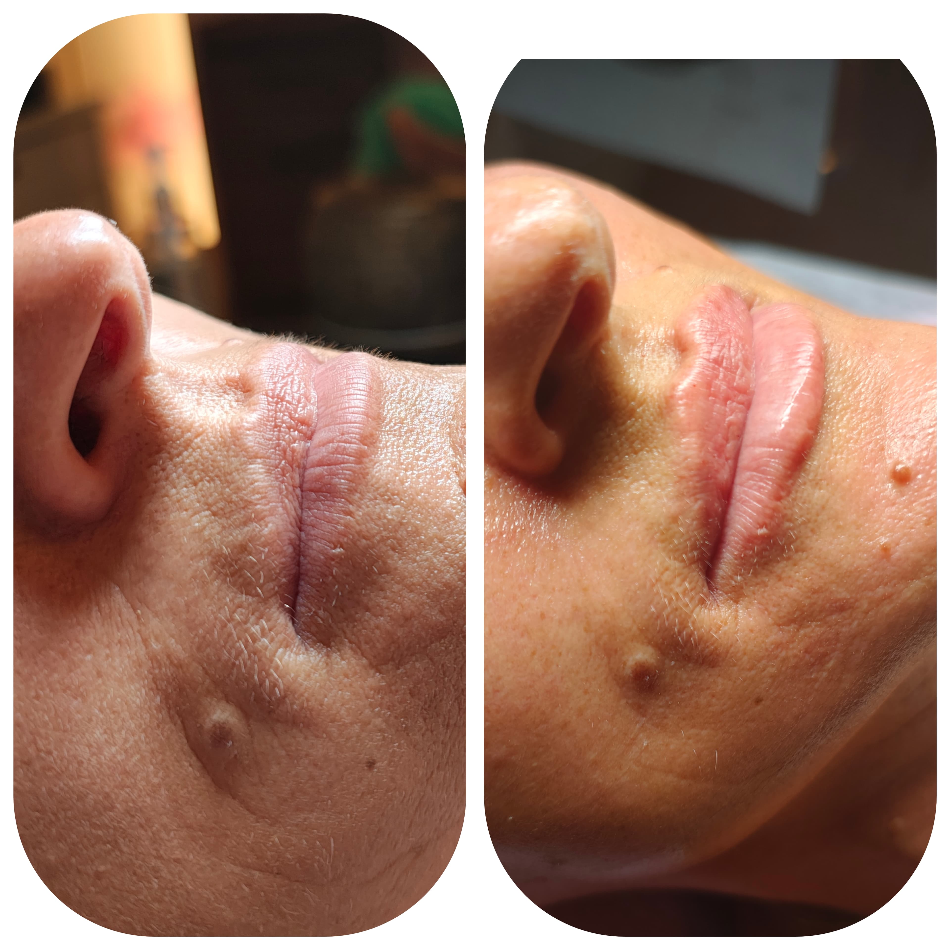 Rezultat zabiegu kosmetologii estetycznej - porównanie przed i po zabiegu